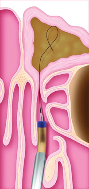 Michael Setzen Otolaryngology, PC great neck, manhattan: rhinology