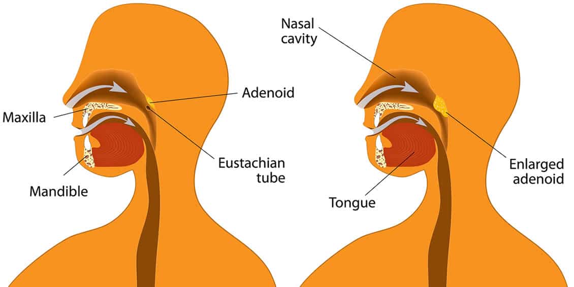 Michael Setzen Otolaryngology, PC great neck, manhattan: andenoidectomy
