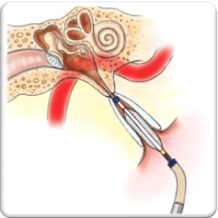 Eustachian Tube Dysfunction, Michael Setzen Otolaryngology