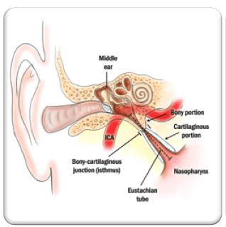 Eustachian Tube Dysfunction | Michael Setzen Otolaryngology